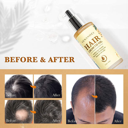 Biotin, Castor & Rosemary Oil for Hair Growth for Women, Hair Loss Treatments for Dry Damaged Hair and Growth, Serum for Thicker Longer Fuller Healthier Hair, All Natural Vitamin Rich Treatment